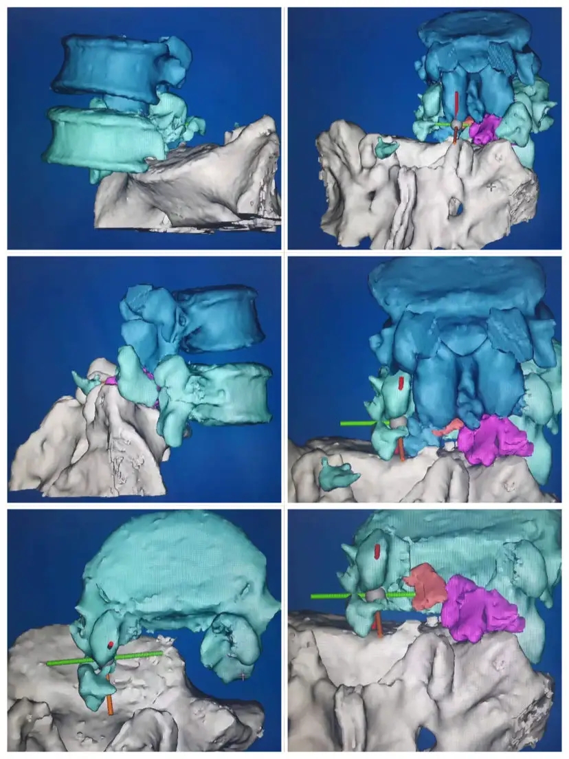 3D打印制作脊柱模型，可以讓更加直觀、立體地了解患者的病情，并制定相應的手術方案或者矯正治療方案。.webp